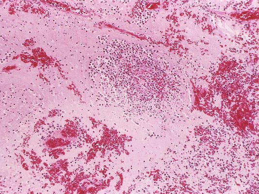 Bubonic plague case confirmed in Michigan