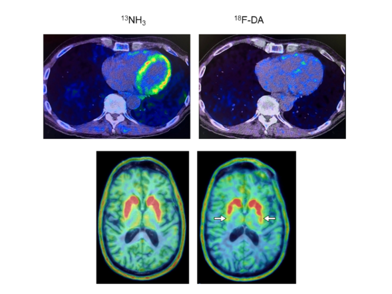 Revolutionary Study Explores Heart PET Scans as Game-Changer for Early Parkinson’s and Lewy Body Dementia Detection
