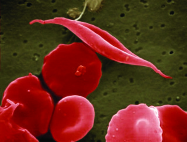 Sickle Cell Affects More Families in Africa and India, but New Gene Therapies Are Out of Reach
